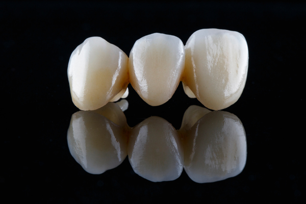 What Causes Dental Bridge Failure?