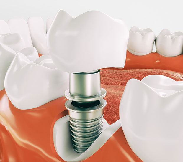 Albuquerque Dental Implant Restoration