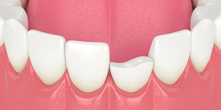 What Should I Do If I Chip My Tooth?, Salud Dental Group, Cracked Tooth?